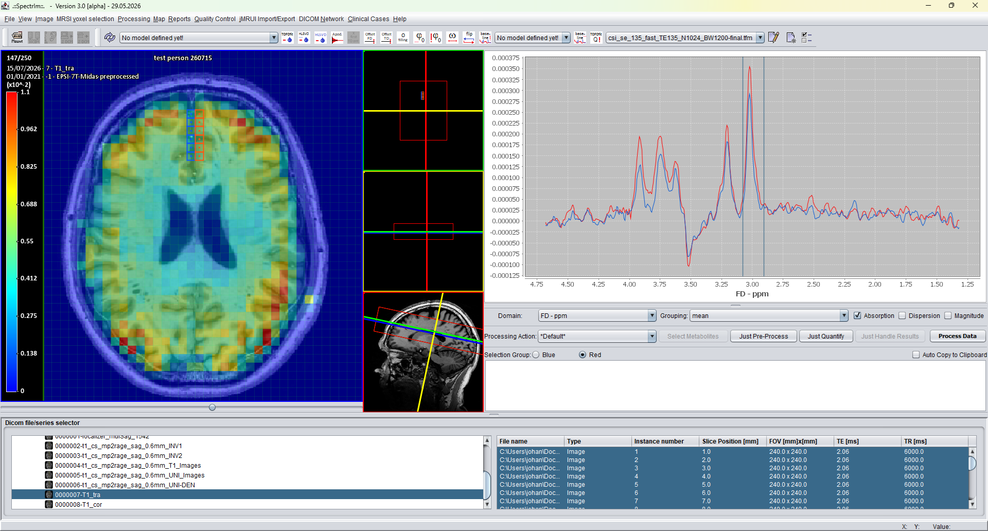 spectrIm-QMRS Clinical Viewer showing an MRSI map overlay and selected spectra