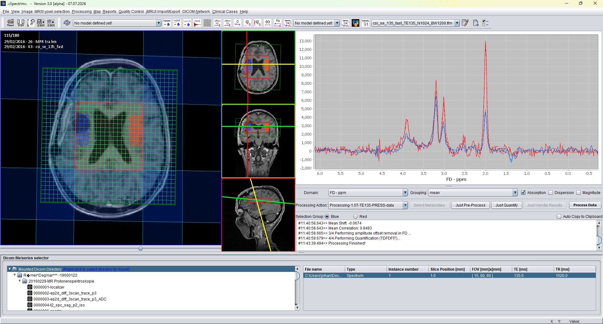 ClinicalViewer comparing tumor infiltration spectra with mirrored opposite-side spectra, showing elevated Cho/Cr, Cho/NAA, and lactate after processing