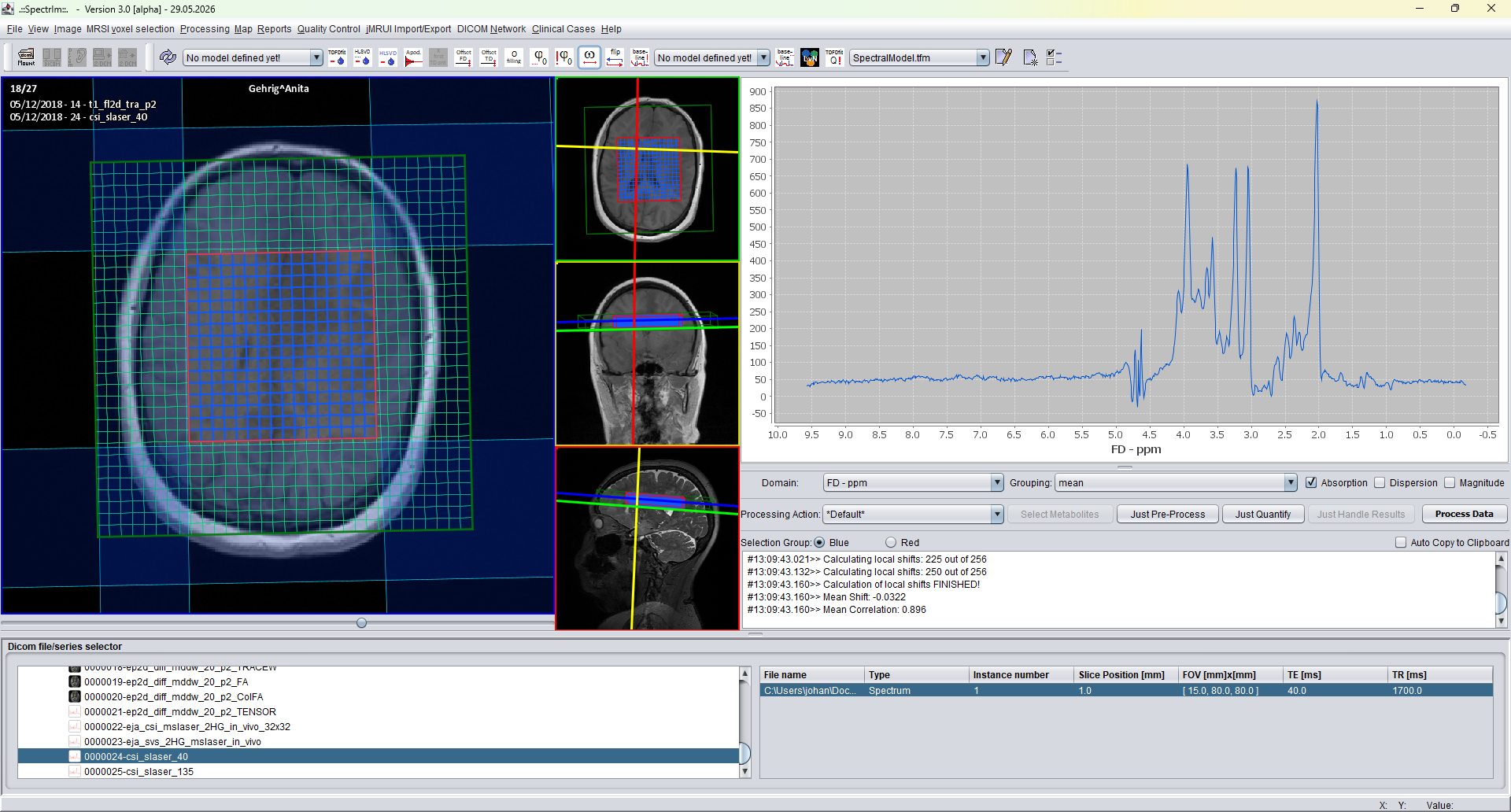 TE 40 ms dataset after HLSVD filtering