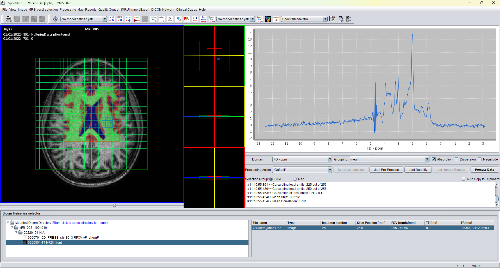 spectrIm-QMRS version 3.0.1 Alpha main viewer with WM GM CSF segmentation overlay