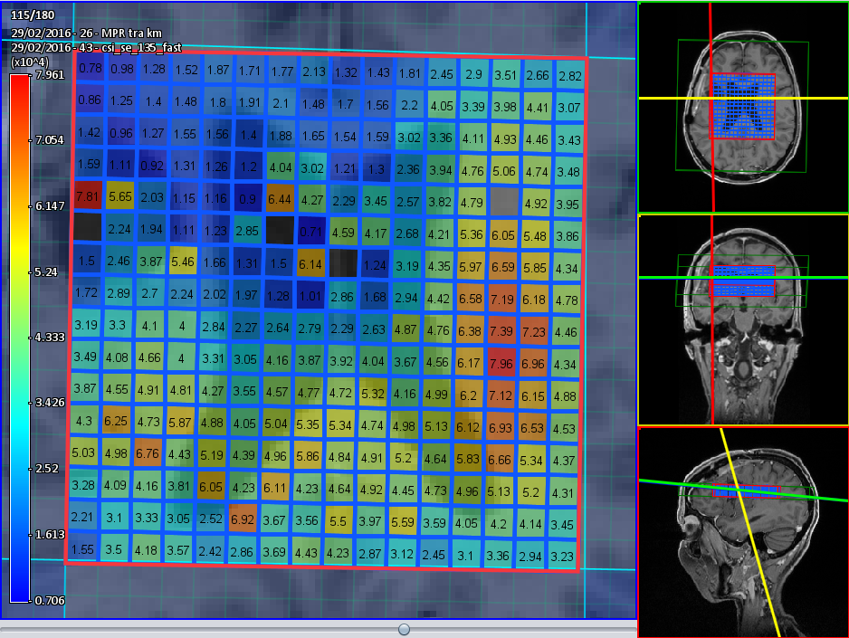 Quantification map displayed as original voxel blocks without interpolation