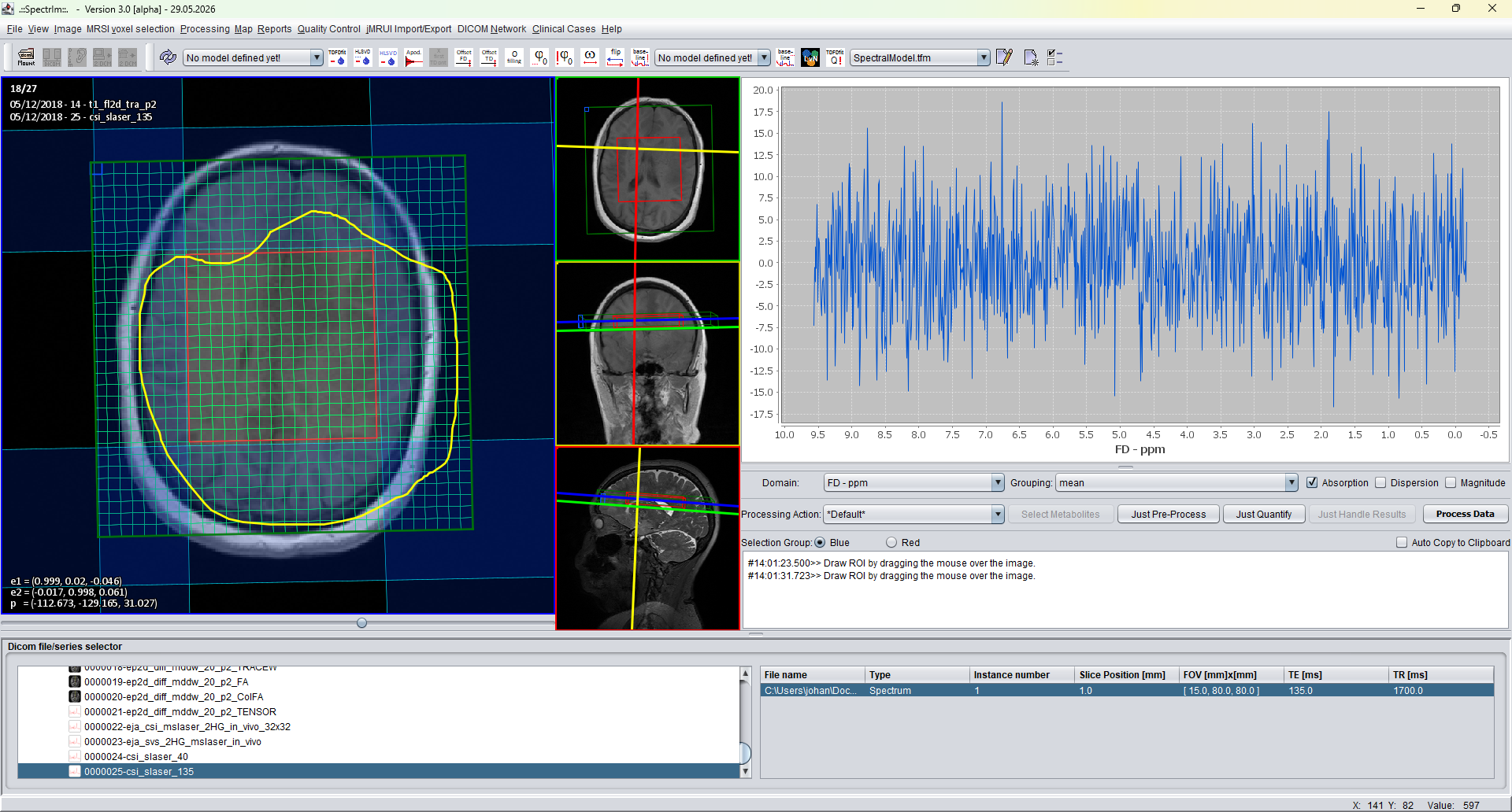 spectrIm-QMRS freehand MRSI voxel selection with yellow drawn contour