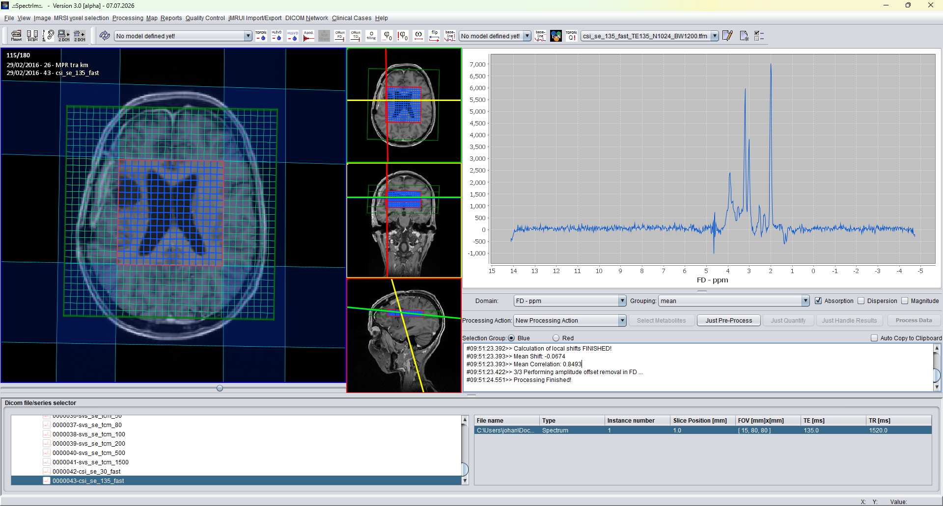Clinical Viewer after default preprocessing with water peak removed