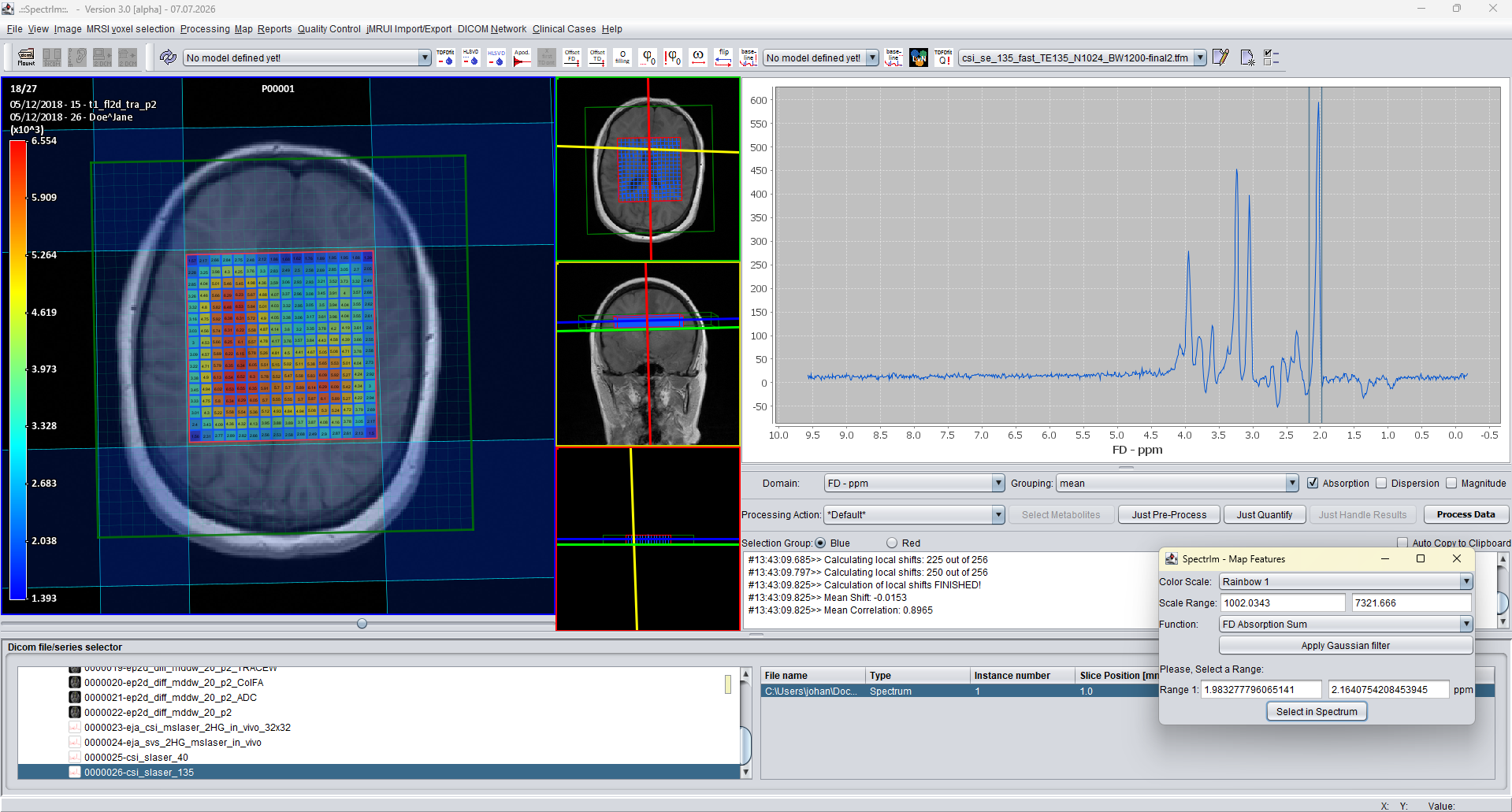 Siemens IDH-mutant glioma spectroscopy DICOM example loaded in spectrIm-QMRS